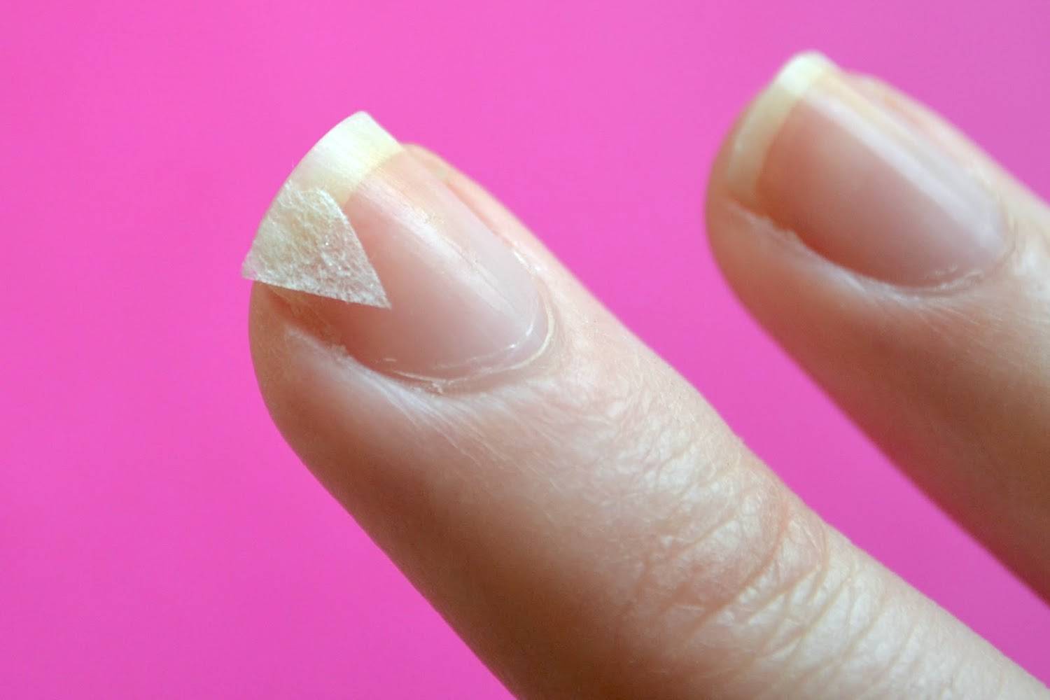 Слоятся ногти: причины и лечение