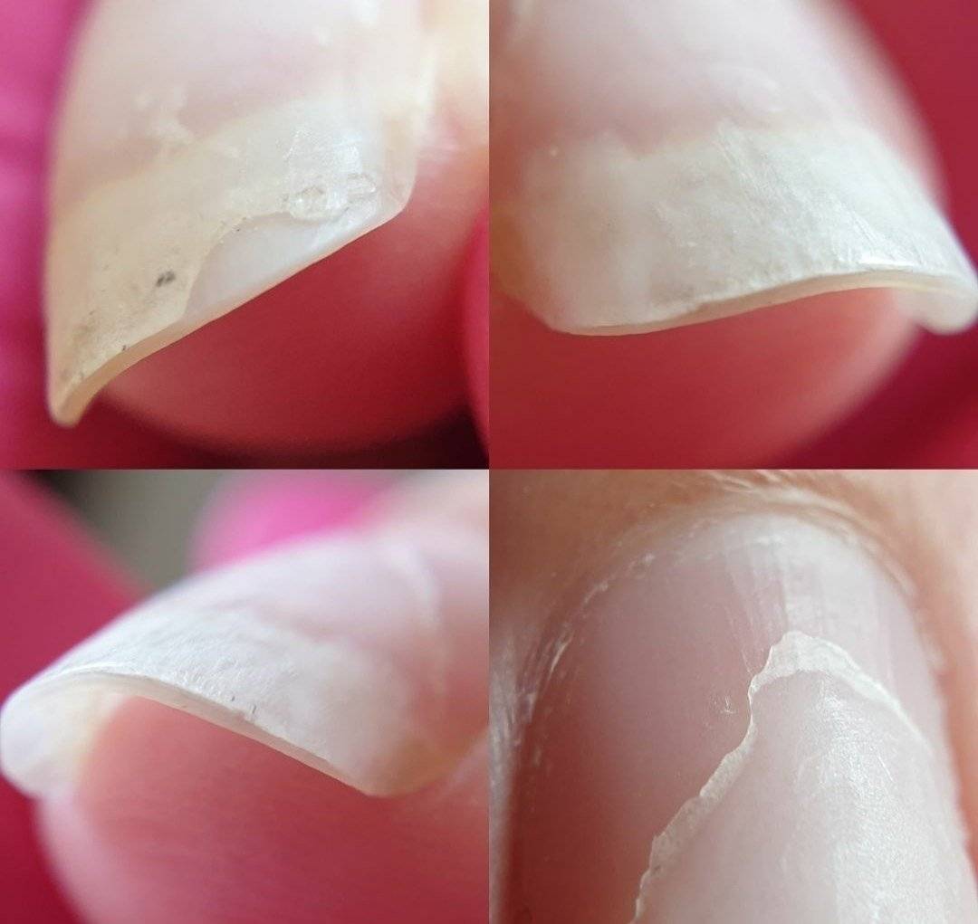 Отлоение ногти от гель лак