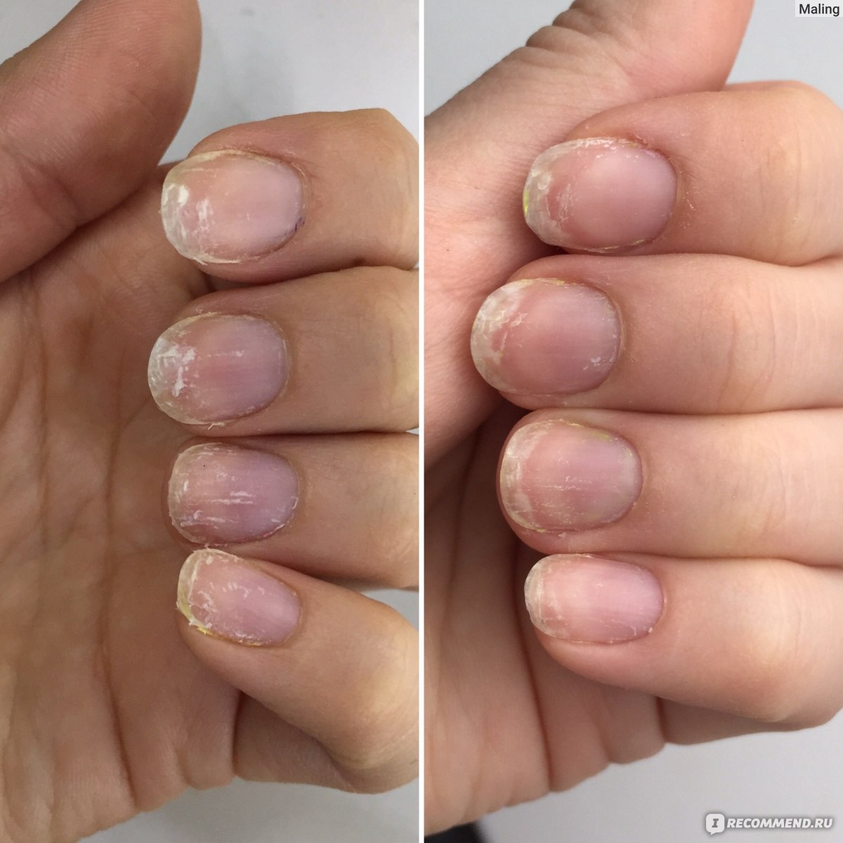 Как восстановить ногти после снятия гель-лака