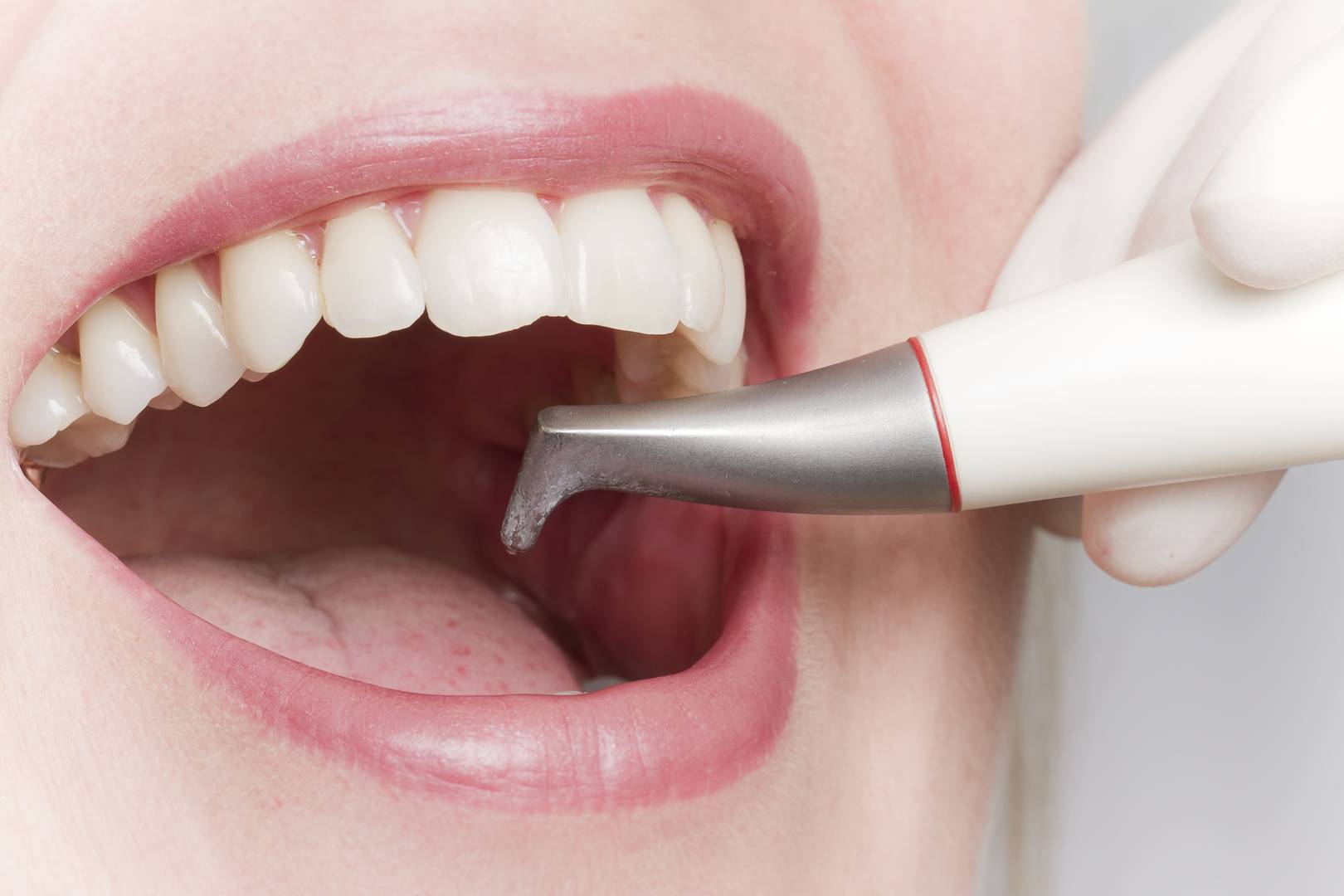 Что лучше — чистка зубов air flow или ультразвуком?