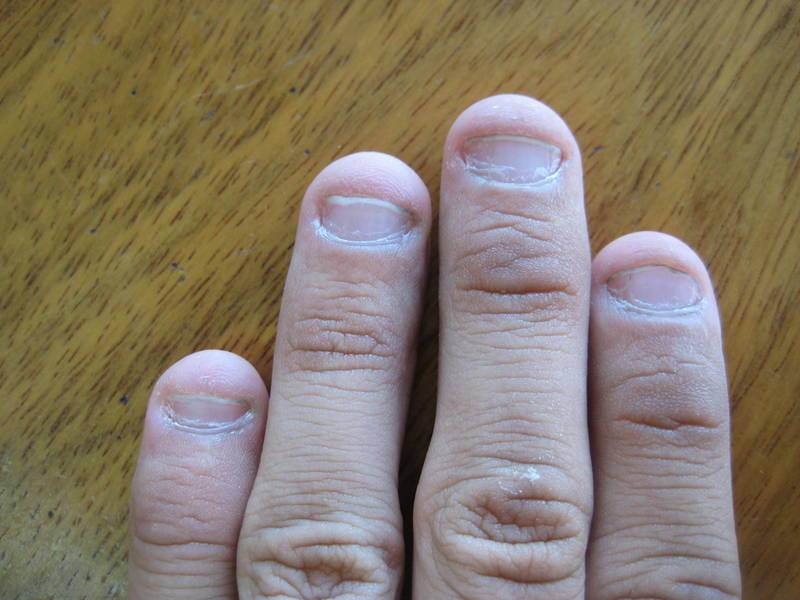 Привычка грызть ногти