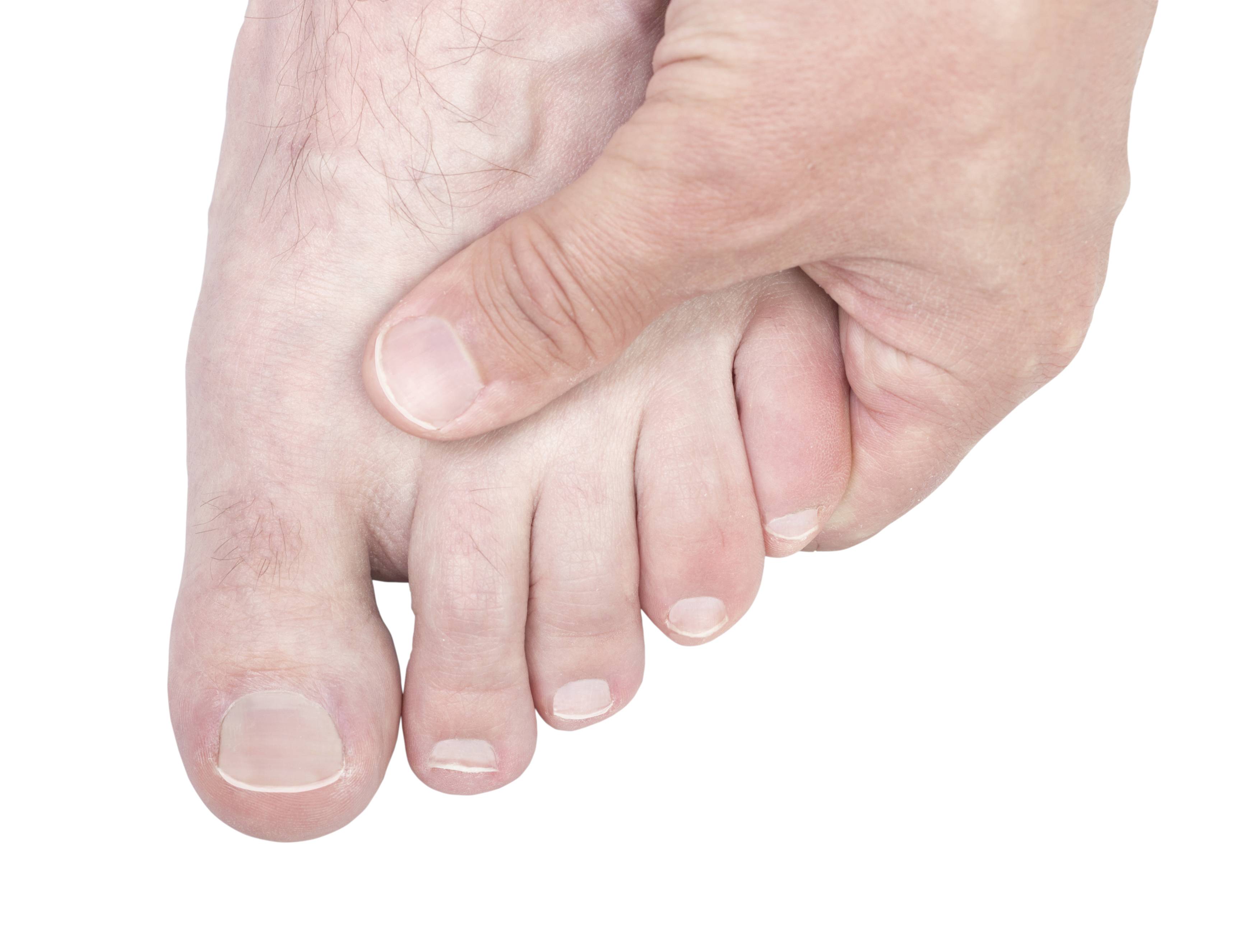 Ушиб пальца на ноге: что делать в домашних условиях, как отличить от перелома