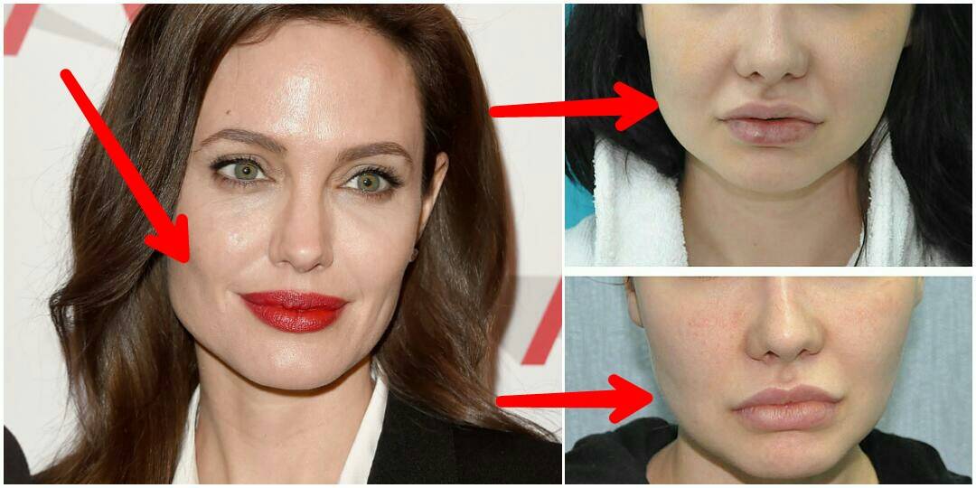 Зачем комки биша. Анджелина Джоли мешки Биша.