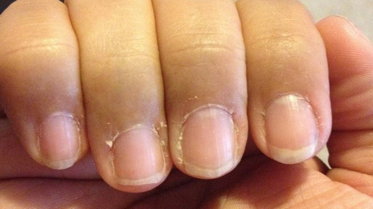Сухая кутикула и кожа вокруг ногтей – устранить в домашних условиях