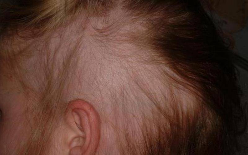 Как справиться с выпадением волос после родов и кормления грудью