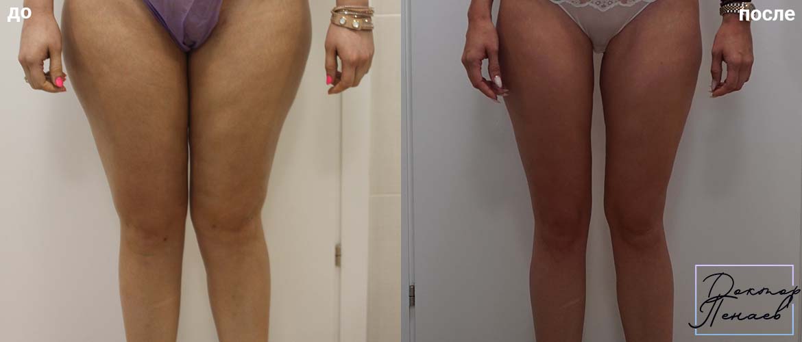 Липосакция голени до и после фото