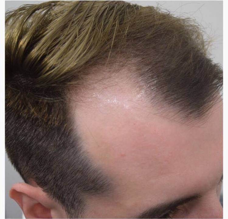 Выпадение волос у женщин: причины, симптомы, лечение выпадения волос после ковида | блог expert clinics