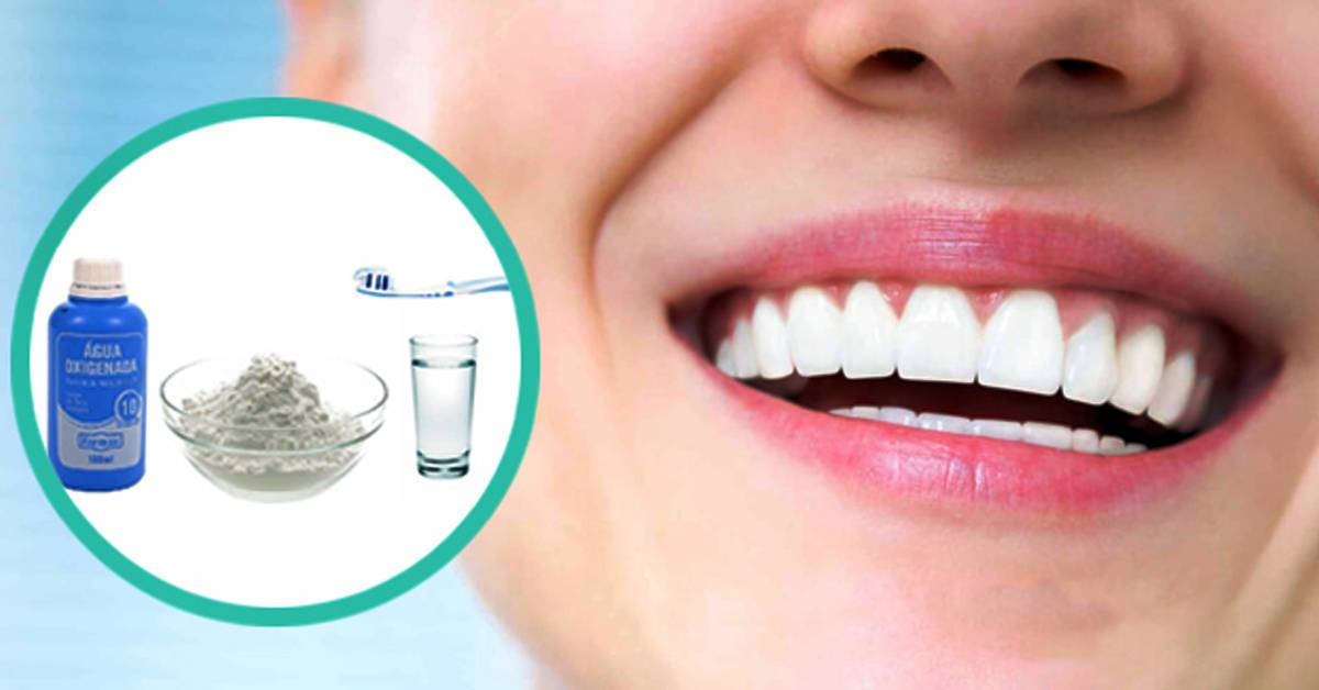 Методы отбеливания зубов перекисью водорода: отзывы, нюансы и правила проведения домашних процедур