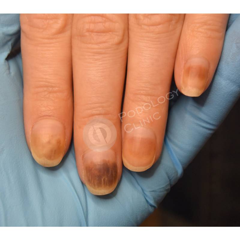 Ноготь отошел от пальца: лечение, почему отходит от кожи