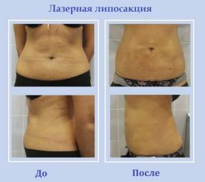 Реабилитация после липосакции по дням, отзывы пациентов