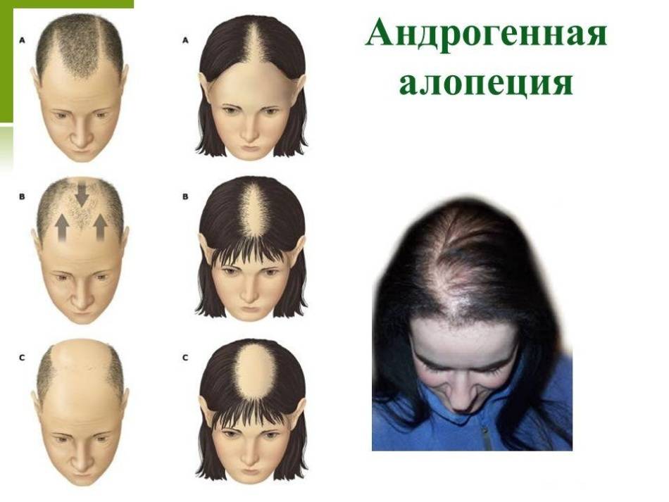 Лечение очаговой алопеции - рекомендации британской ассоциации дерматологов (перевод и адаптация проф. святенко) - медицинский центр профессора святенко