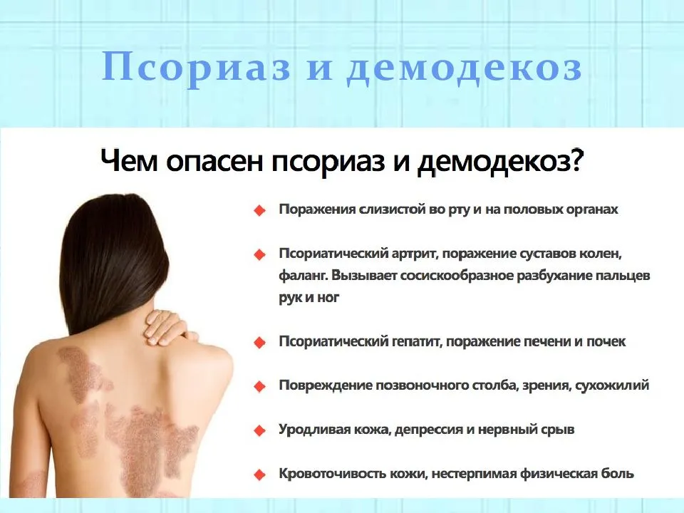Шелушение кожи головы: причины, лечение - клиника «доктор волос»
