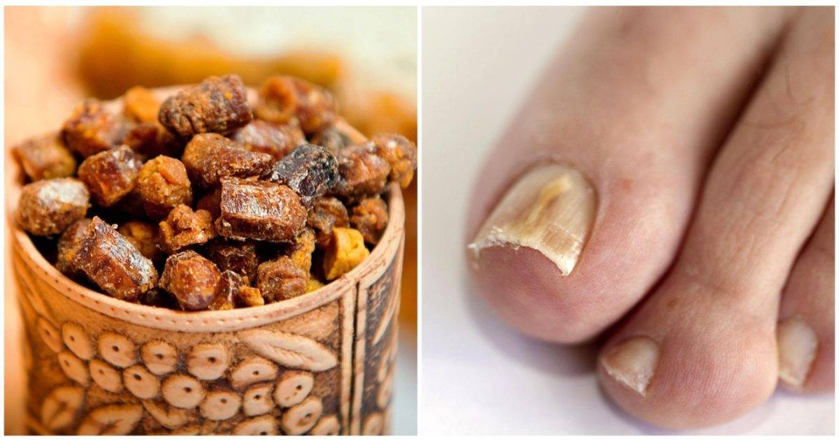 Народные средства от грибка ногтей на ногах, быстрое и эффективное лечение