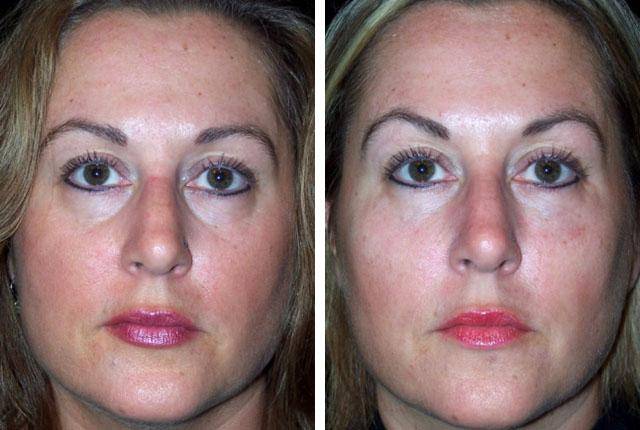 Инъекции гиалуроновой кислоты для лица (губы, под глаза, лоб). Фото до и после