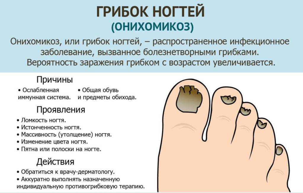 Профилактика грибка ногтей