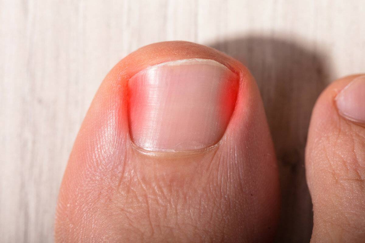 Что делать при ушибе ногтя и как избежать отслоения