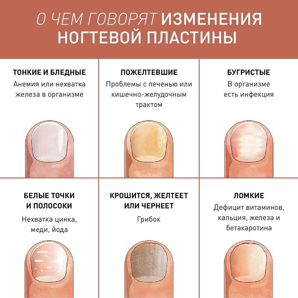 Что ногти говорят о состоянии здоровья человека: фото, диагностика проблем по виду ногтей