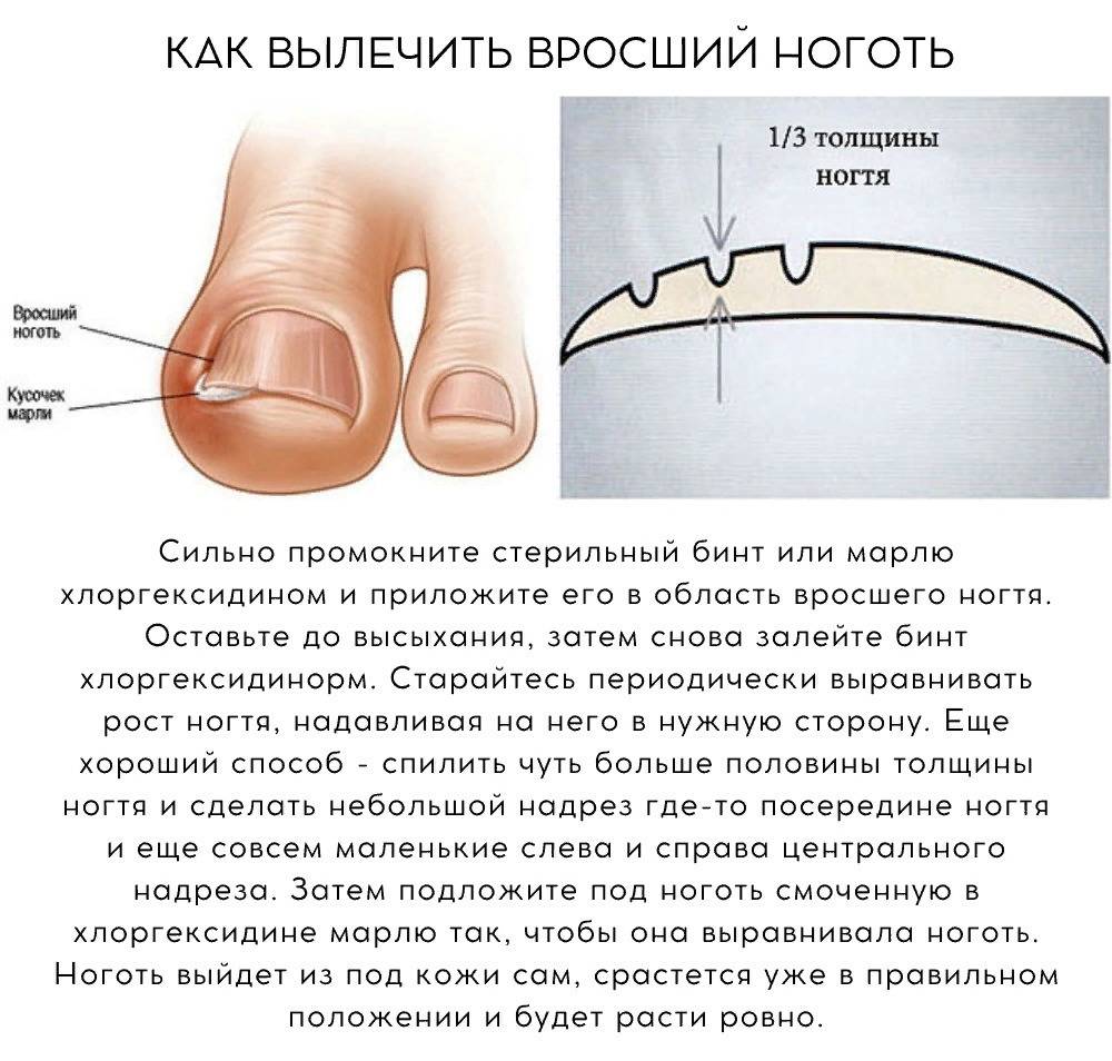 Что делать с врастанием ногтя: симптомы, лечение