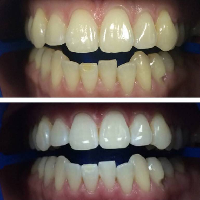 Zoom 3 метод для отбеливания зубов: преимущества, недостатки и отзывы