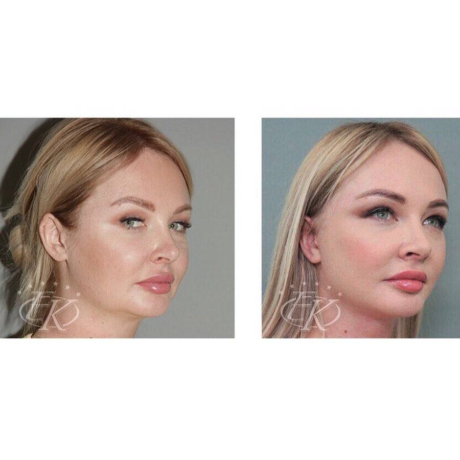 Дарья пынзарь до и после пластической операции