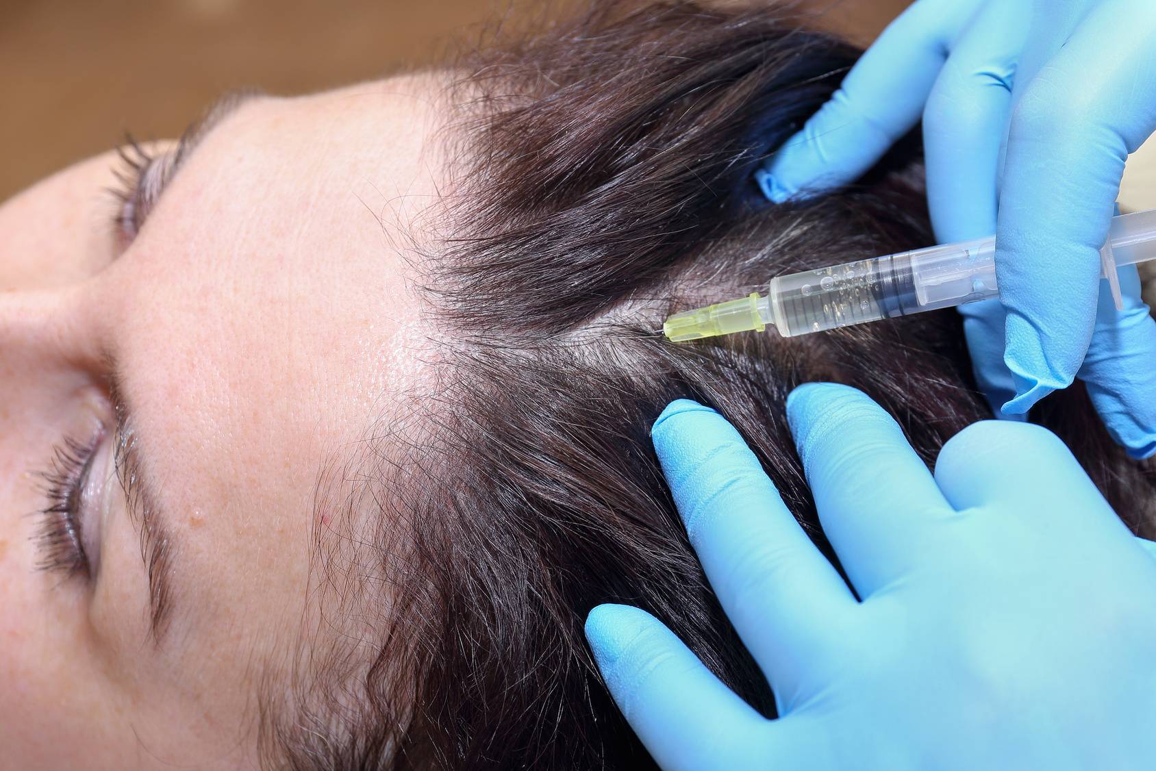 Мезотерапия для волос | суть методики мезотерапии для волосистой части головы