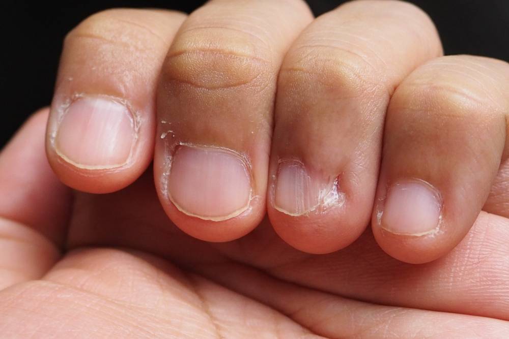 Лак чтобы не грызть ногти – способ избавиться от вредной привычки