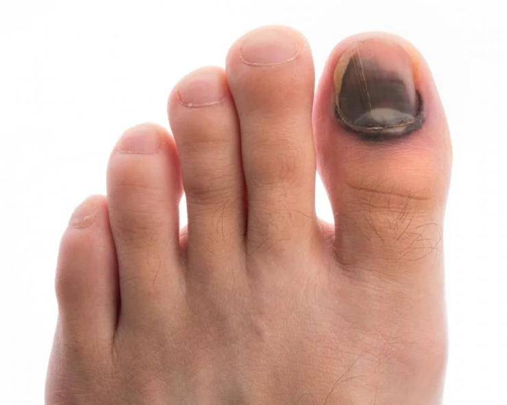 Ушиб пальца на ноге: что делать и чем лечить в домашних условиях