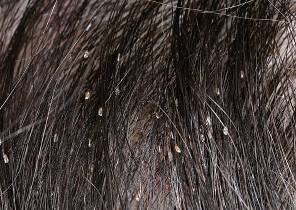 ❶ как отличить перхоть от гнид на волосах, фото чем они отличаются