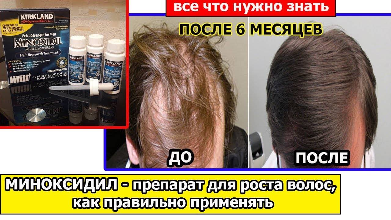 Миноксидил — препарат для роста волос, как правильно применять