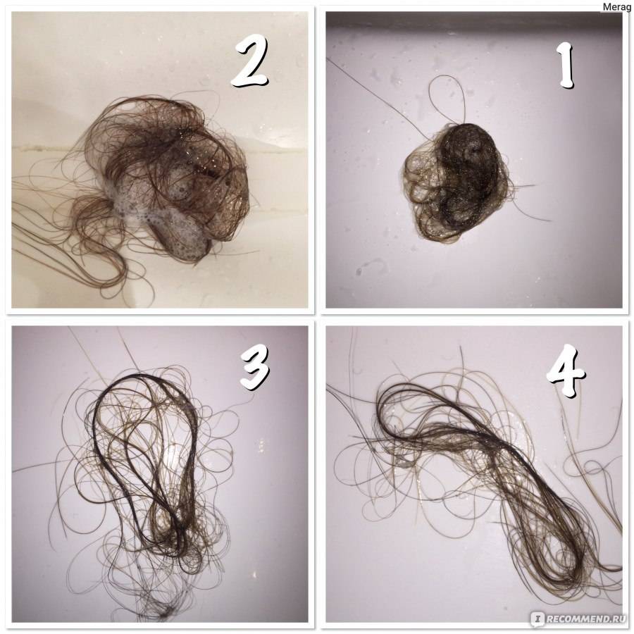 Рост волос на теле у женщины, симптомы и лечение роста волос на теле у женщине.
