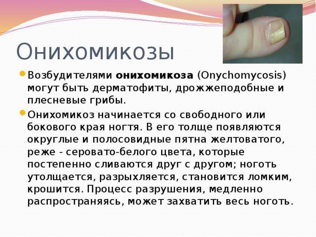 Как лечить грибок ногтей на руках | ogribke.ru