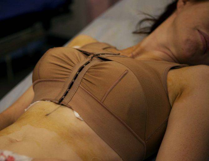 Реабилитация после маммопластики (увеличения груди) — самая полная инструкция по восстановлению