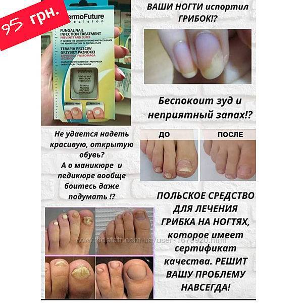 Народные средства от грибка ногтей на ногах, быстрое и эффективное лечение