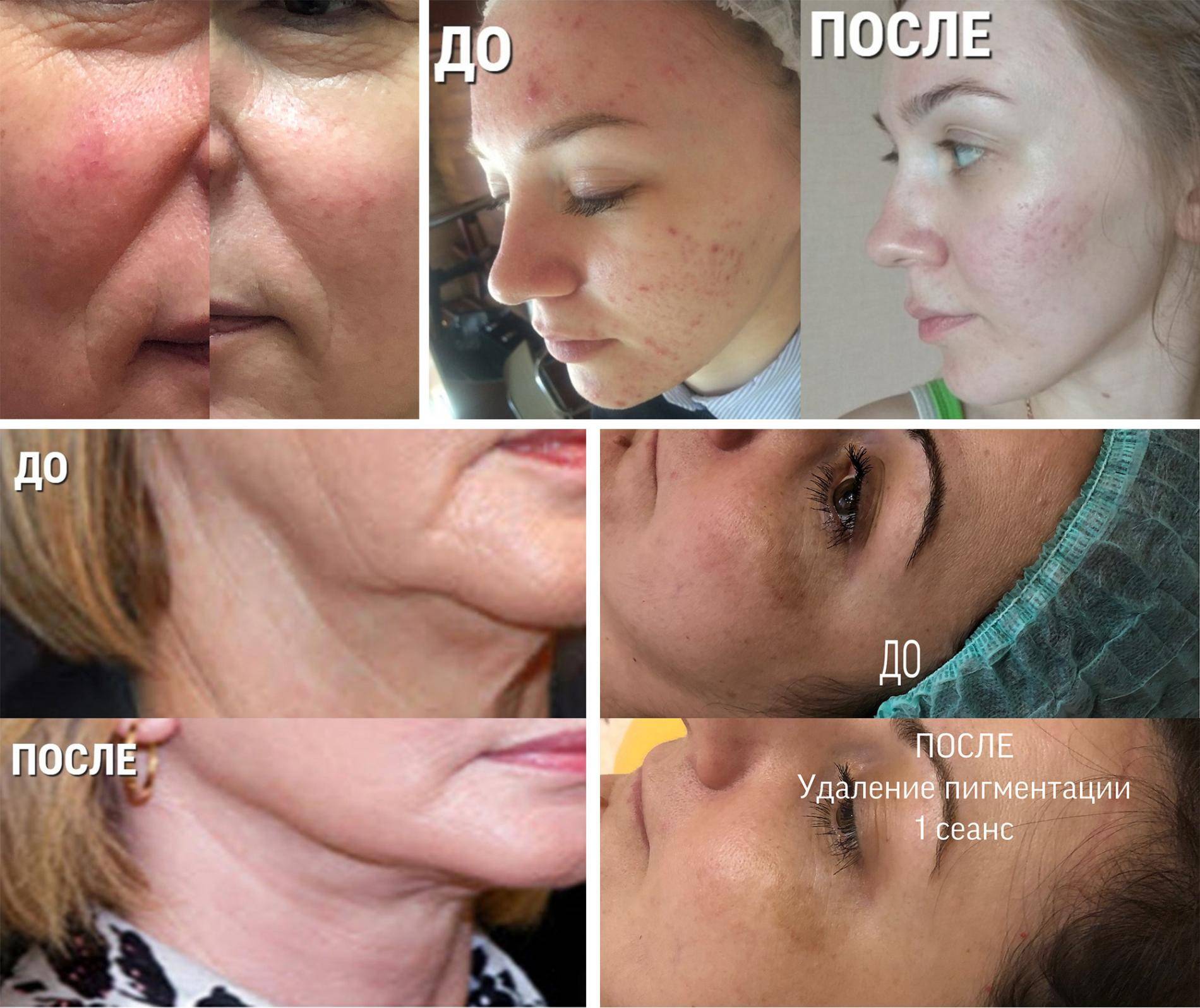 Аквашайн биоревитализация * отзывы косметологов с фото до и после клиентов