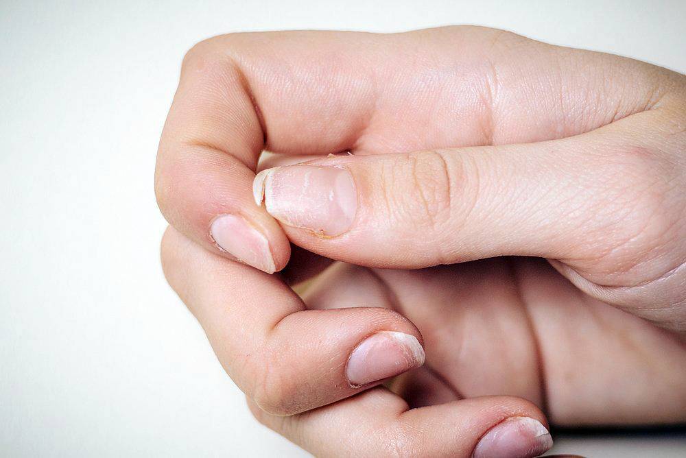 Слоящиеся ногти: причины, способы устранить расслаивание