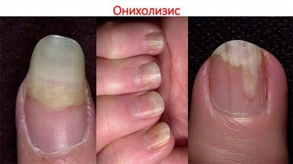 Почему нарощенные ногти быстро отваливаются