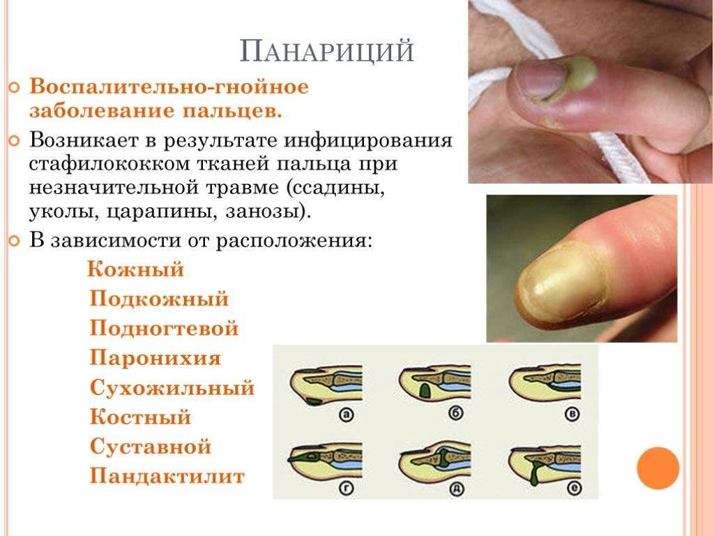 Панариций, опухоль ногтя пальца, причина и симптомы