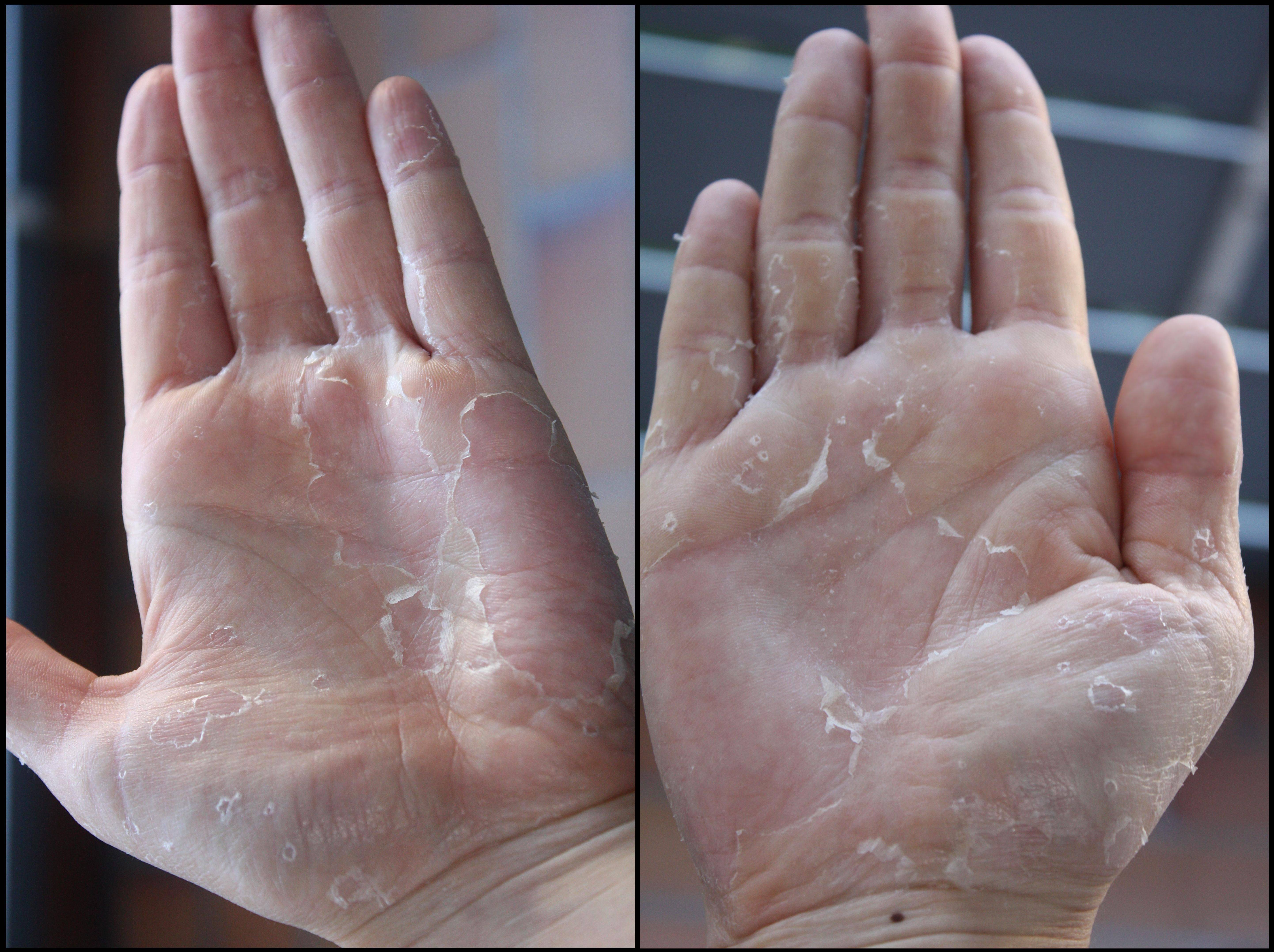 Трескается кожа на пальцах рук: 115 фото причин и способов лечения кожи