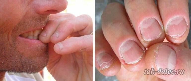 Как перестать грызть ногти раз и навсегда: 10 проверенных способов