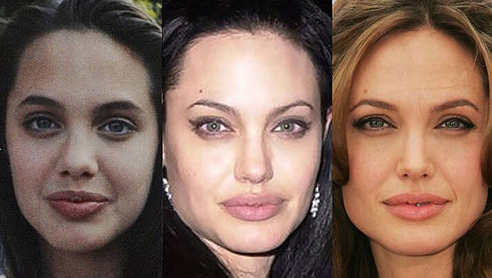 Анджелина джоли до и после пластики груди, щек, носа. фото актрисы до и после операций ринопластики, плазмолифтинга