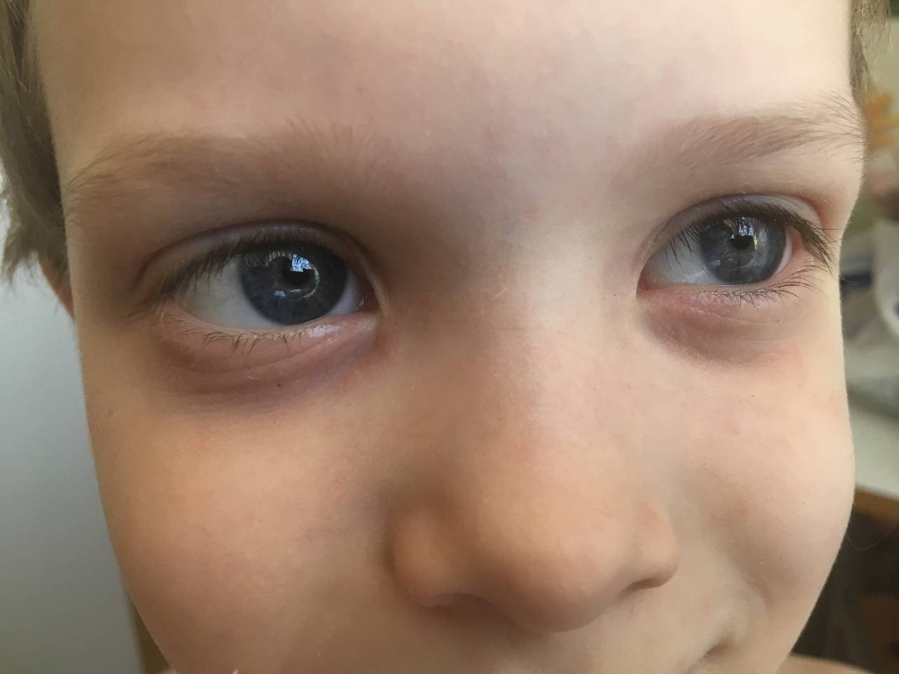 Красные круги под глазами у ребенка - что это, причины, лечение симптома