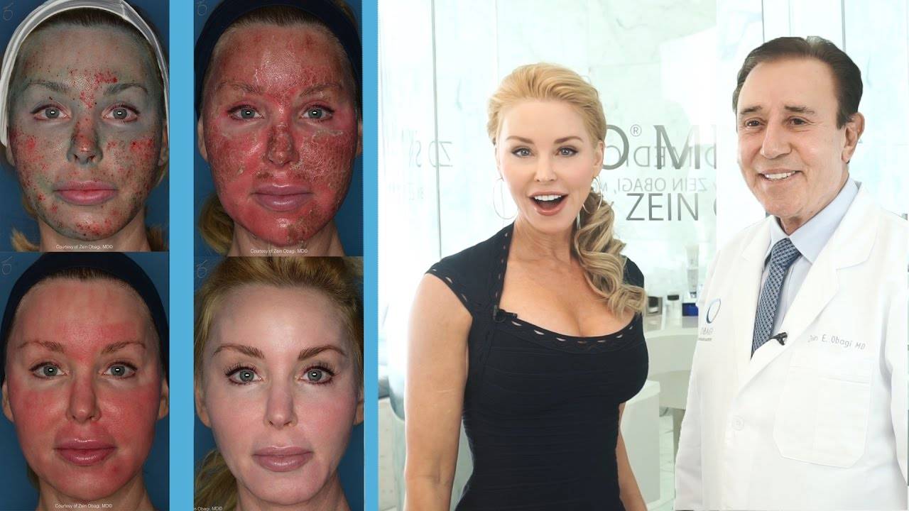 Феноловый пилинг лица: фото до и после, отзывы | frau-madam.com