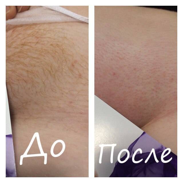 Шугаринг бикини