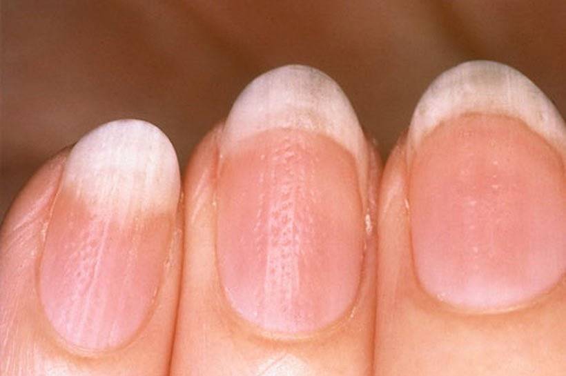 Онихолизис - отслоение ногтей: причины, симптомы, лечение