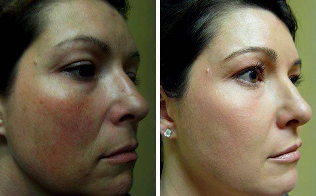Уход за кожей после лазерных процедур: 6 этапов и обзор 16 средств