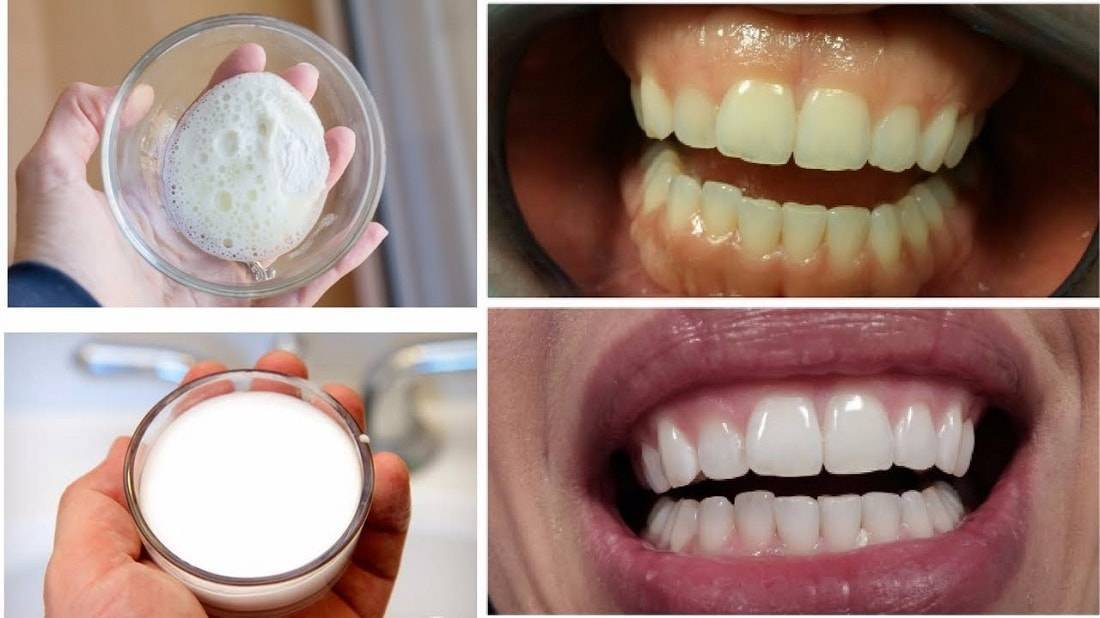 отбеливание зубов сода
