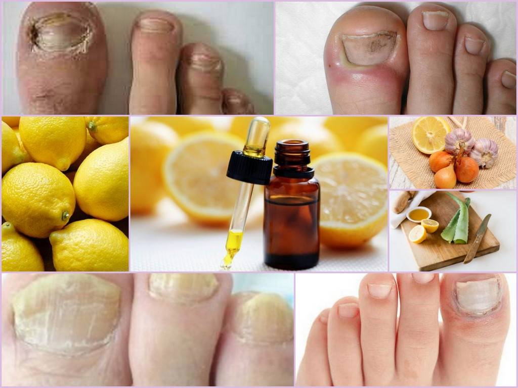 ᐉ грибок ногтей на ногах и руках лечение народными средствами в домашних условиях