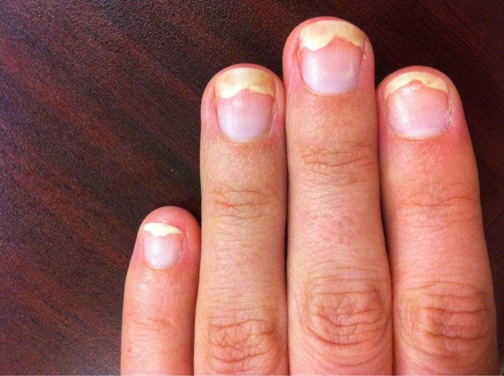 Почему цветут ногти на руках и что это значит?