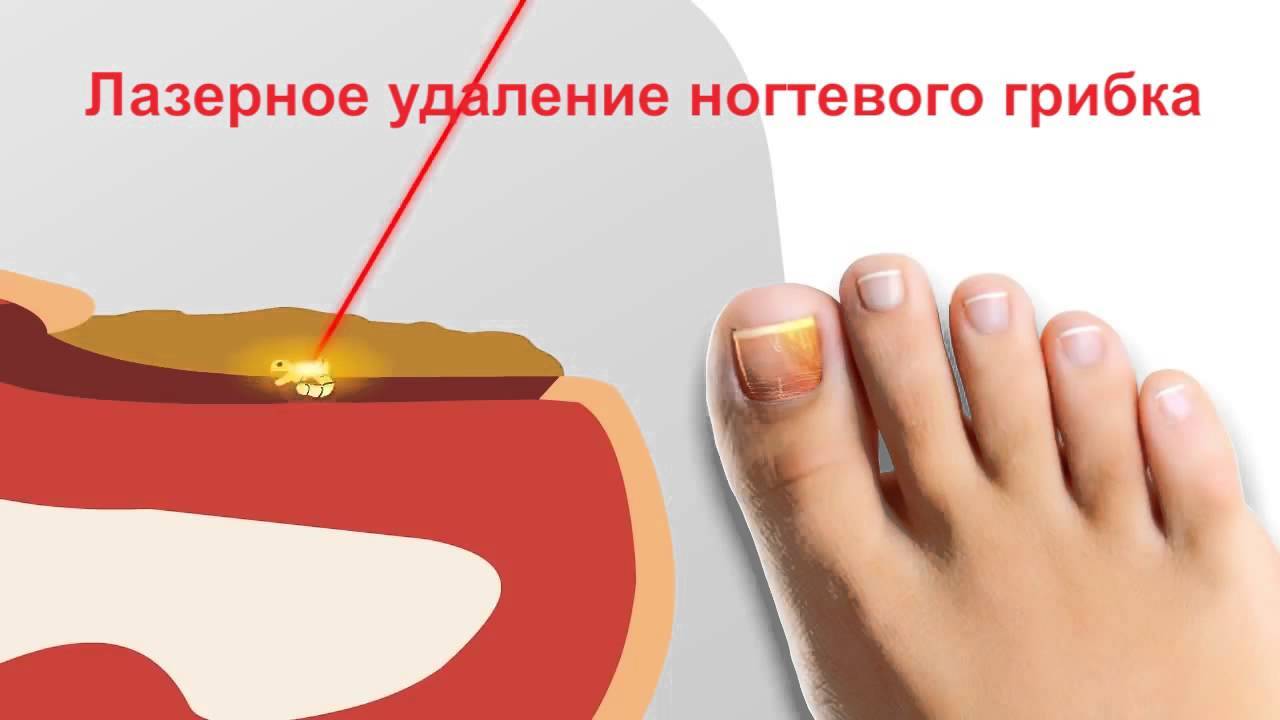 Лечение онихомикоза ногтей лазером | избавим от грибка | амара