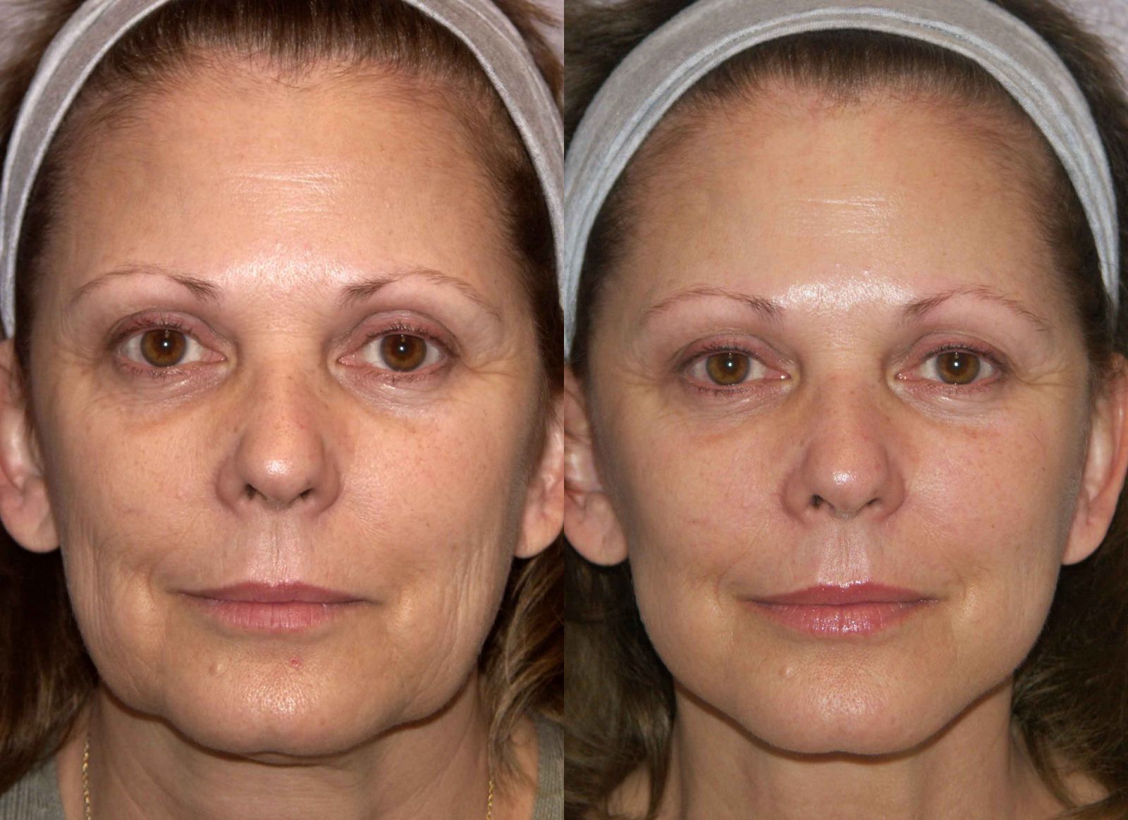 Rf лифтинг лица фото до и после одной процедуры